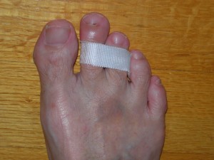 my broken toe taped to next toe July 28,2011
